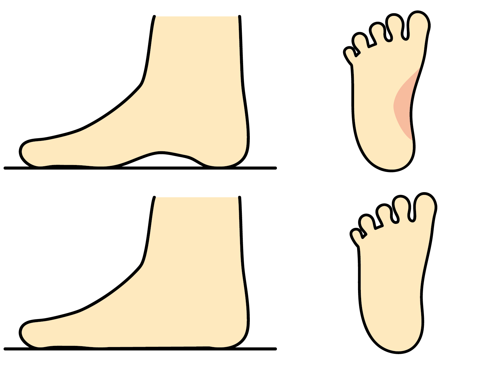 偏平足の足と健康な足について、土踏まずの有無を比較