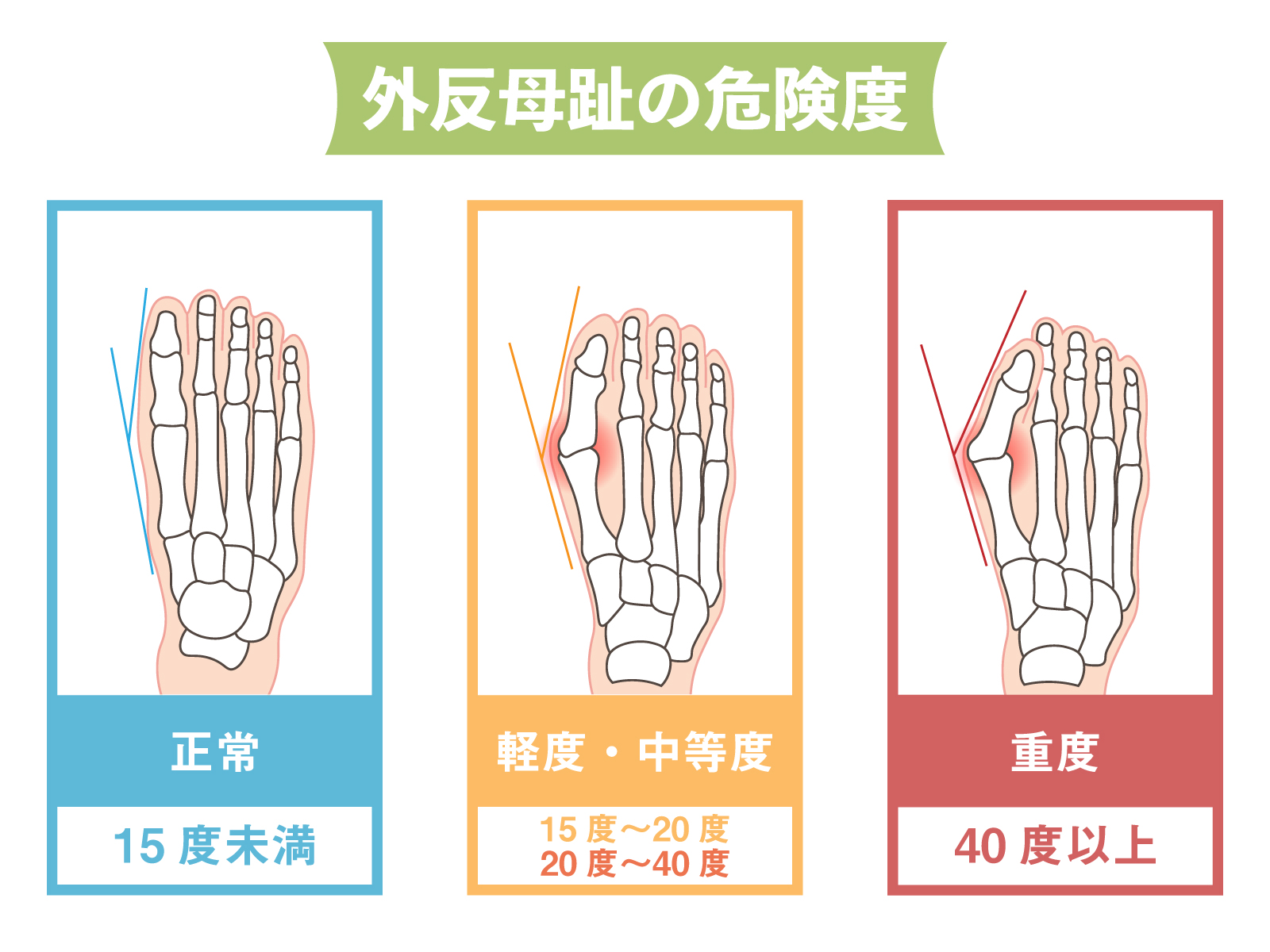 外反母趾角を危険度別に三段階で表した図です。